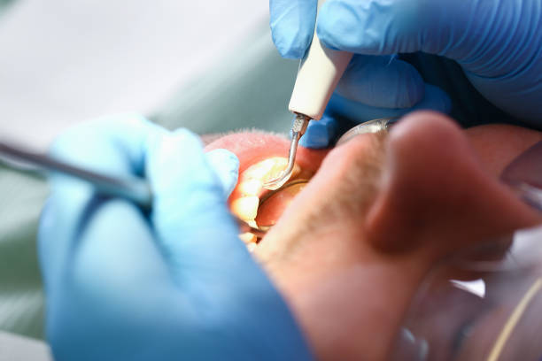 Best Emergency Tooth Extraction in Jenison, MI